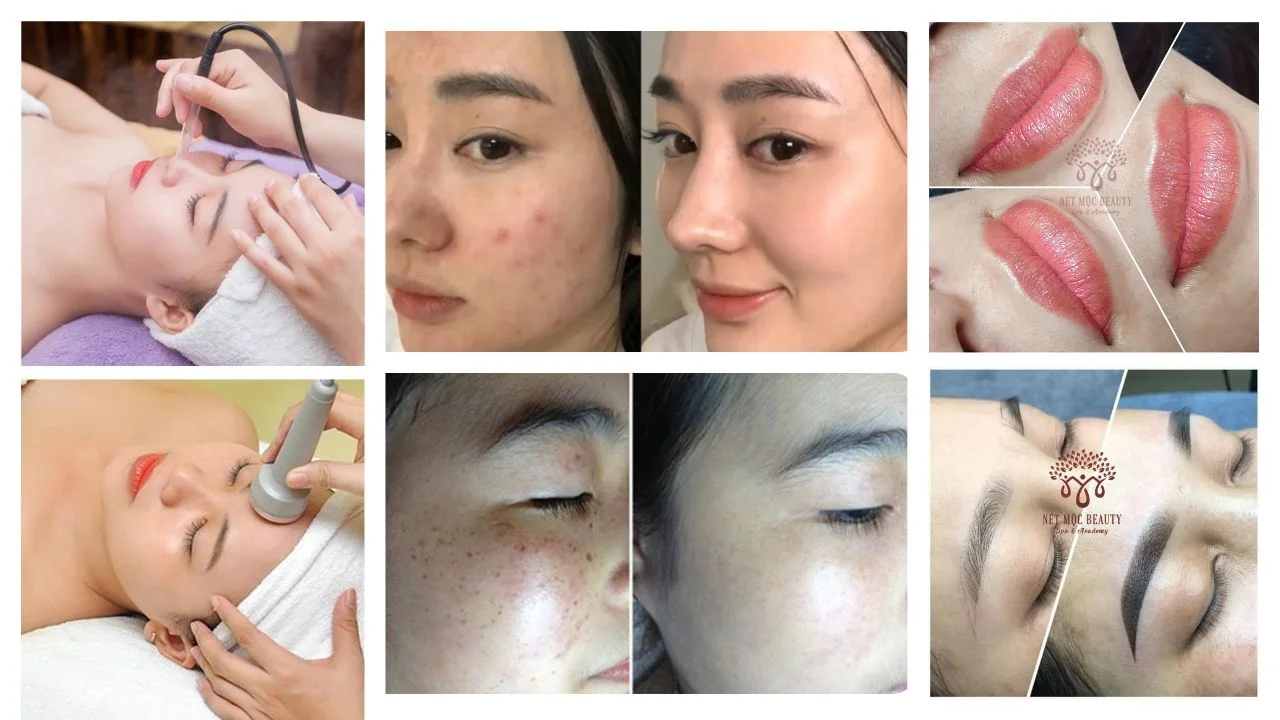 Spa trị nám Cần Thơ