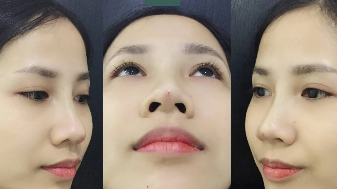 Địa chỉ tiêm filler botox tại Cần Thơ