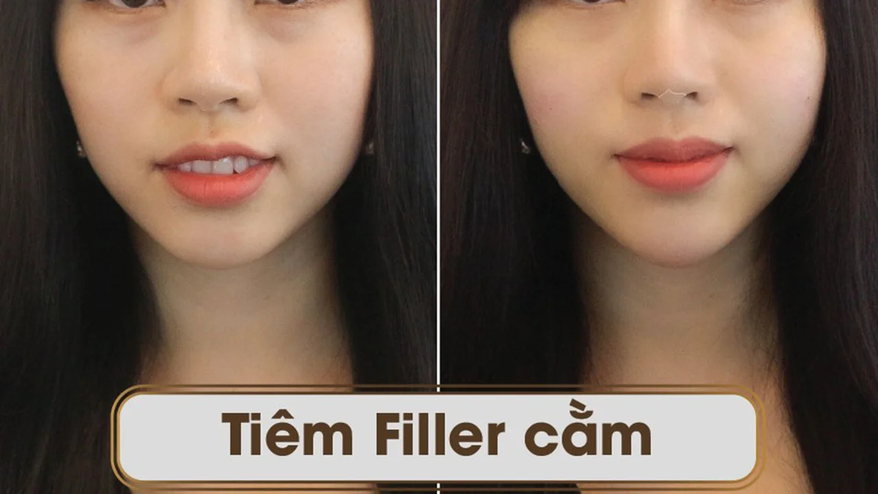 Địa chỉ tiêm filler botox tại Cần Thơ