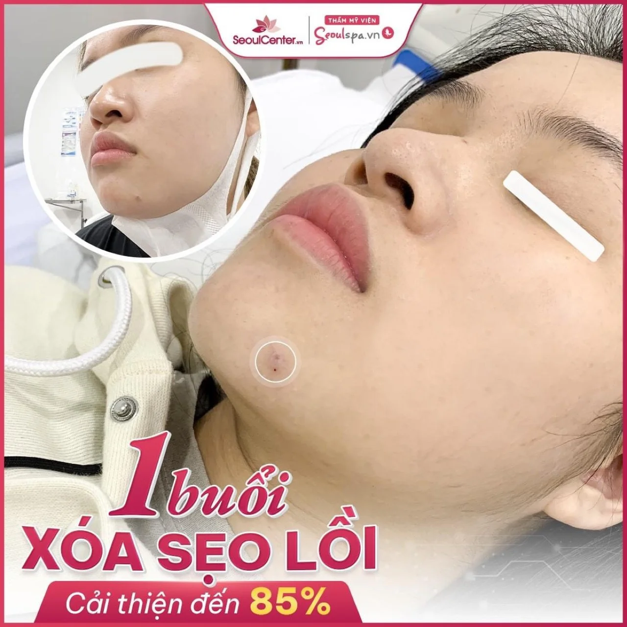 SeoulSpa.Vn Cần Thơ trị sẹo cực uy tín